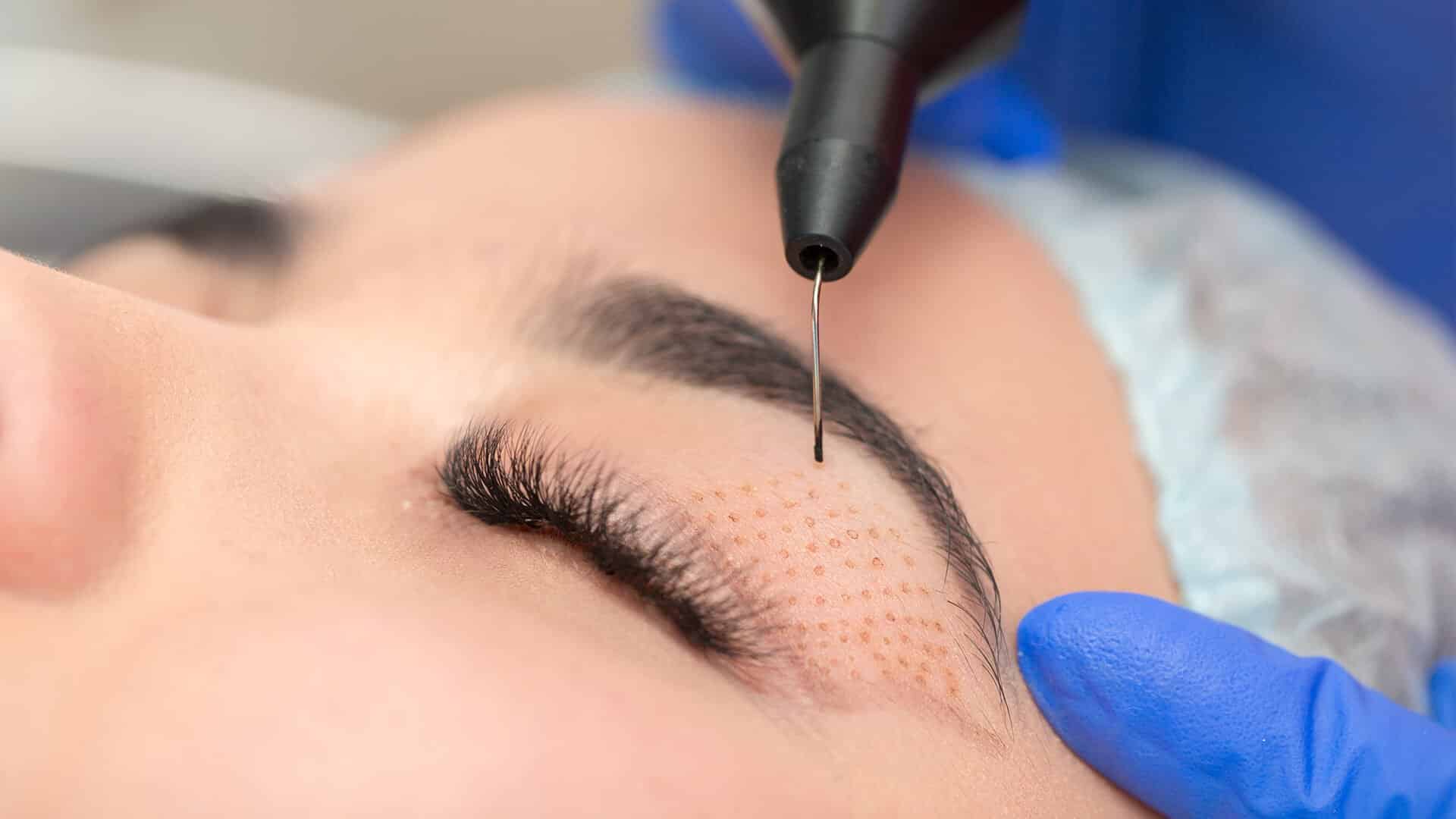 Ameliyatsız Göz Kapağı Estetiği (Plexr®)