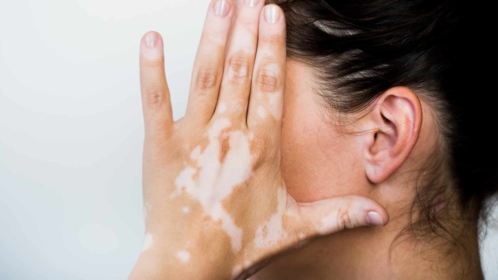 Vitiligo